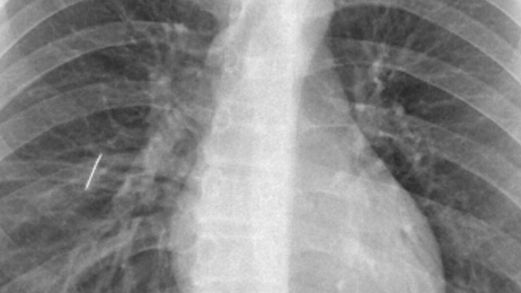 Equipo médico del Hospital Interzonal San Juan Bautista de Catamarca en quirófano